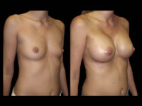 Breast Before After Photos Breast Augmentation Before After Photos Case #13447 - Pancholi Cosmetic Surgery