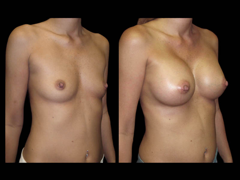 Breast Before After Photos Breast Augmentation Before After Photos Case #13447 - Pancholi Cosmetic Surgery