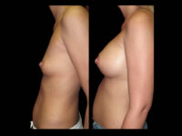 Breast Before After Photos Breast Augmentation Before After Photos Case #13448 - Pancholi Cosmetic Surgery