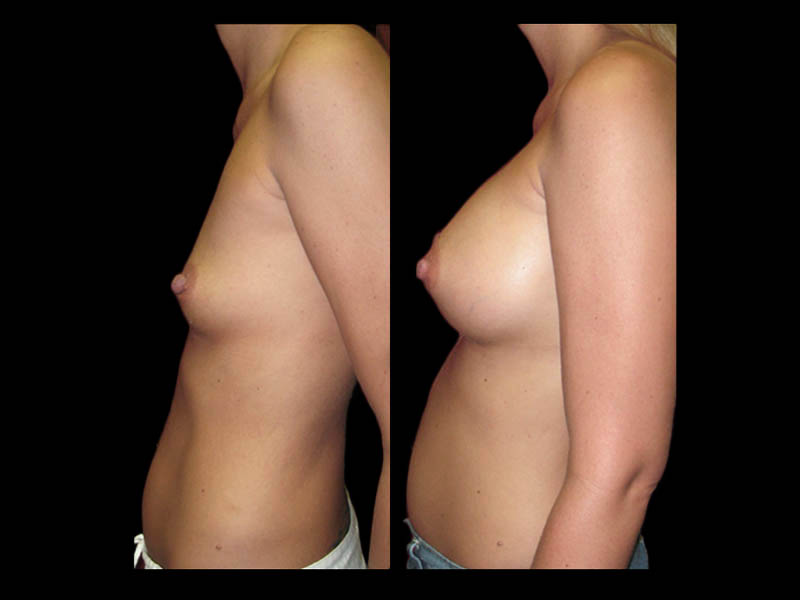 Breast Before After Photos Breast Augmentation Before After Photos Case #13448 - Pancholi Cosmetic Surgery