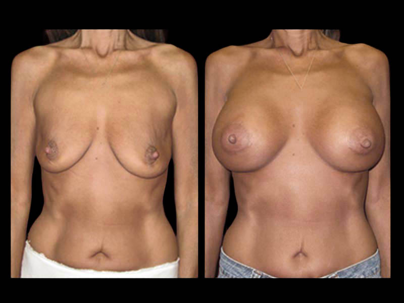 Breast Before After Photos Breast Augmentation Before After Photos Case #13450 - Pancholi Cosmetic Surgery