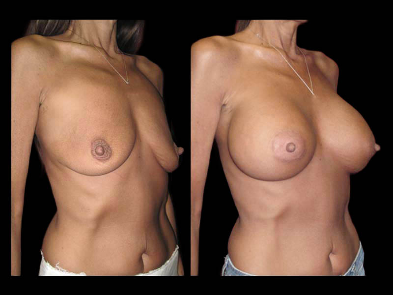 Breast Before After Photos Breast Augmentation Before After Photos Case #13451 - Pancholi Cosmetic Surgery