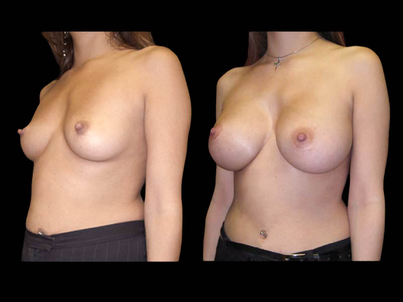 Breast Before After Photos Breast Augmentation Before After Photos Case #13453 - Pancholi Cosmetic Surgery