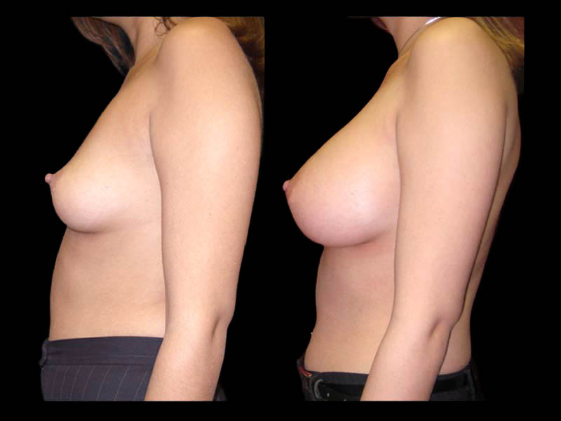 Breast Before After Photos Breast Augmentation Before After Photos Case #13454 - Pancholi Cosmetic Surgery