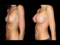 Breast Before After Photos Breast Augmentation Before After Photos Case #13456 - Pancholi Cosmetic Surgery