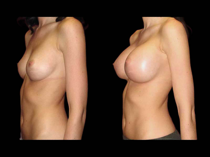 Breast Before After Photos Breast Augmentation Before After Photos Case #13456 - Pancholi Cosmetic Surgery