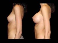 Breast Before After Photos Breast Augmentation Before After Photos Case #13457 - Pancholi Cosmetic Surgery