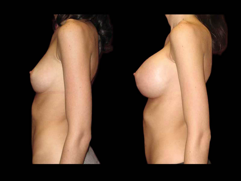 Breast Before After Photos Breast Augmentation Before After Photos Case #13457 - Pancholi Cosmetic Surgery