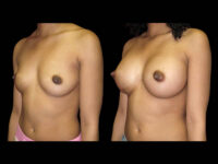 Breast Before After Photos Breast Augmentation Before After Photos Case #13460 - Pancholi Cosmetic Surgery