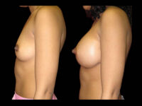 Breast Before After Photos Breast Augmentation Before After Photos Case #13461 - Pancholi Cosmetic Surgery
