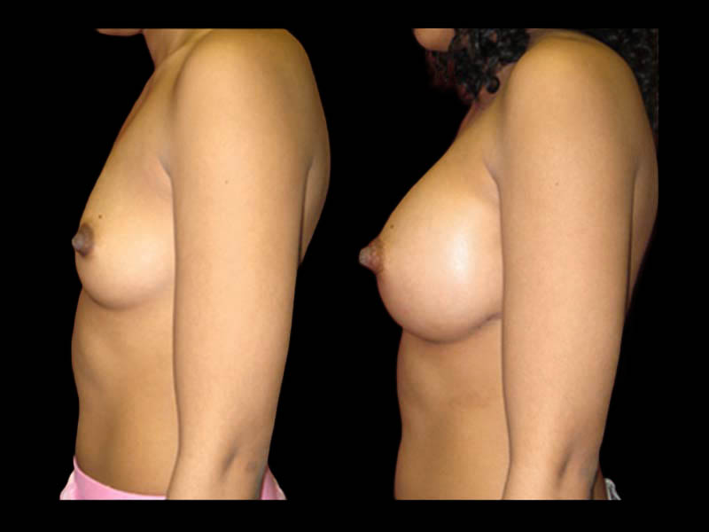 Breast Before After Photos Breast Augmentation Before After Photos Case #13461 - Pancholi Cosmetic Surgery