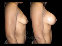 Breast Before After Photos Breast Implant Replacement Before After Photos Case #13553 - Pancholi Cosmetic Surgery