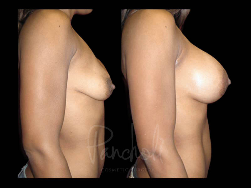 Breast Before After Photos Breast Implant Replacement Before After Photos Case #13553 - Pancholi Cosmetic Surgery
