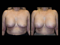 Breast Before After Photos Breast Implant Replacement Before After Photos Case #13555 - Pancholi Cosmetic Surgery