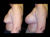 Breast Before After Photos Breast Implant Replacement Before After Photos Case #13556 - Pancholi Cosmetic Surgery