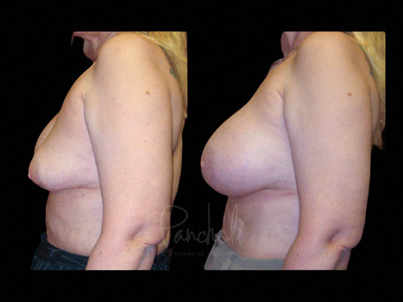 Breast Before After Photos Breast Implant Replacement Before After Photos Case #13556 - Pancholi Cosmetic Surgery
