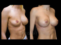Breast Before After Photos Breast Implant Replacement Before After Photos Case #13558 - Pancholi Cosmetic Surgery