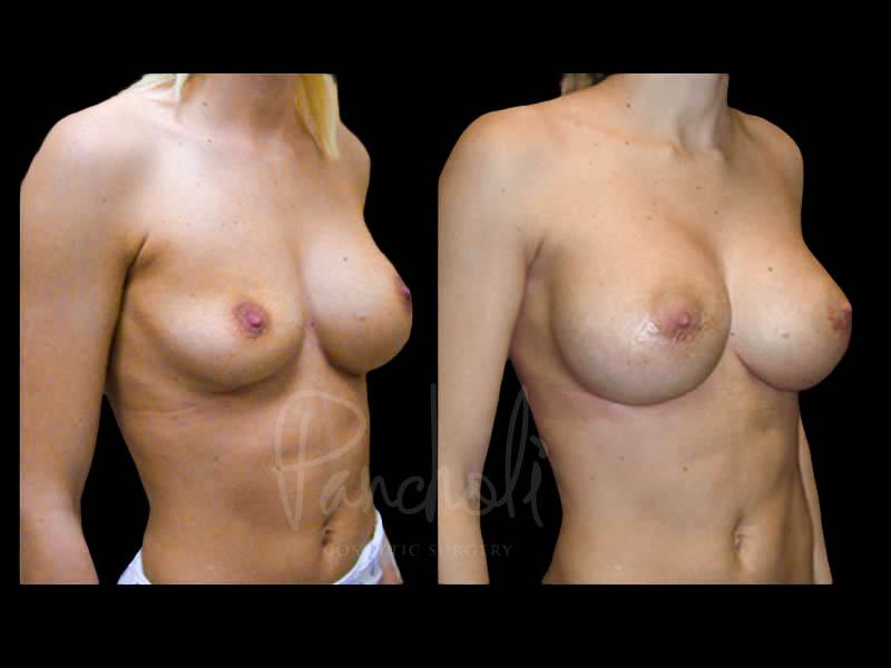 Breast Before After Photos Breast Implant Replacement Before After Photos Case #13558 - Pancholi Cosmetic Surgery