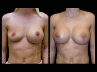 Breast Before After Photos Breast Implant Replacement Before After Photos Case #13559 - Pancholi Cosmetic Surgery
