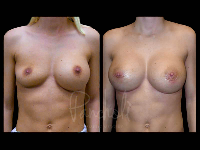 Breast Before After Photos Breast Implant Replacement Before After Photos Case #13559 - Pancholi Cosmetic Surgery
