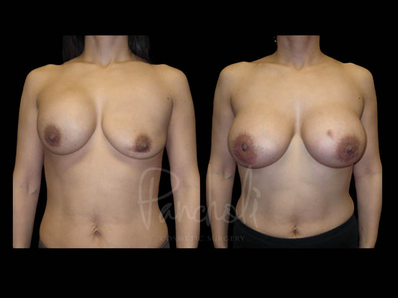 Breast Before After Photos Breast Implant Replacement Before After Photos Case #13561 - Pancholi Cosmetic Surgery