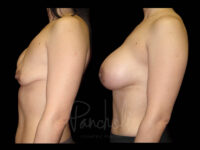 Breast Before After Photos Breast Implant Replacement Before After Photos Case #13562 - Pancholi Cosmetic Surgery