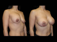 Breast Before After Photos Breast Implant Replacement Before After Photos Case #13563 - Pancholi Cosmetic Surgery