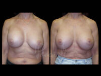 Breast Before After Photos Breast Implant Replacement Before After Photos Case #13565 - Pancholi Cosmetic Surgery