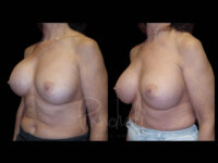 Breast Before After Photos Breast Implant Replacement Before After Photos Case #13566 - Pancholi Cosmetic Surgery
