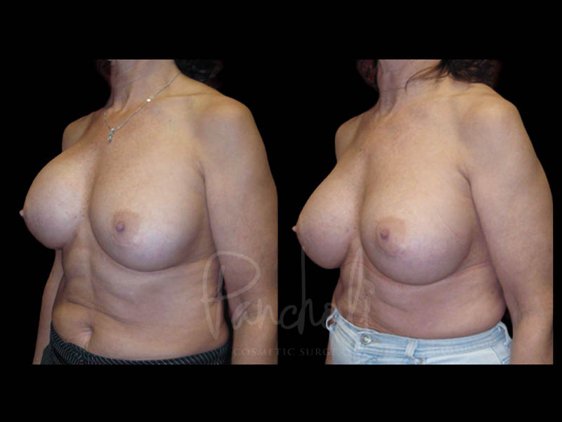 Breast Before After Photos Breast Implant Replacement Before After Photos Case #13566 - Pancholi Cosmetic Surgery