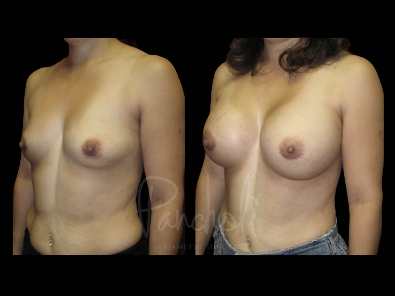 Breast Before After Photos Breast Implant Replacement Before After Photos Case #13569 - Pancholi Cosmetic Surgery
