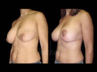 Breast Before After Photos Breast Implant Replacement Before After Photos Case #13572 - Pancholi Cosmetic Surgery