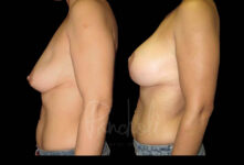 Breast Before After Photos Breast Implant Replacement Before After Photos Case #13573 - Pancholi Cosmetic Surgery