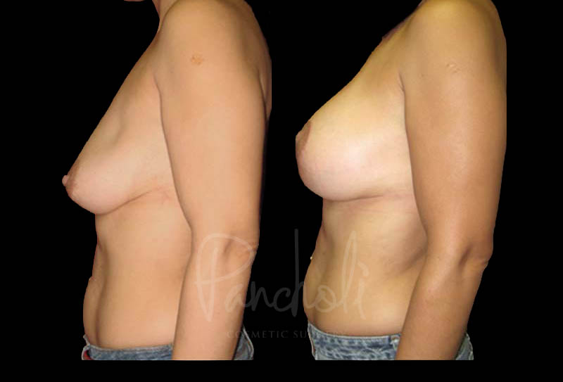 Breast Before After Photos Breast Implant Replacement Before After Photos Case #13573 - Pancholi Cosmetic Surgery