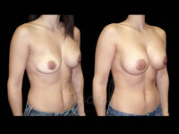 Breast Before After Photos Breast Implant Replacement Before After Photos Case #13575 - Pancholi Cosmetic Surgery