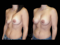 Breast Before After Photos Breast Implant Replacement Before After Photos Case #13576 - Pancholi Cosmetic Surgery