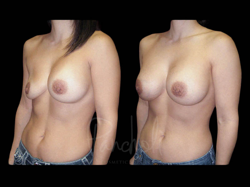 Breast Before After Photos Breast Implant Replacement Before After Photos Case #13576 - Pancholi Cosmetic Surgery