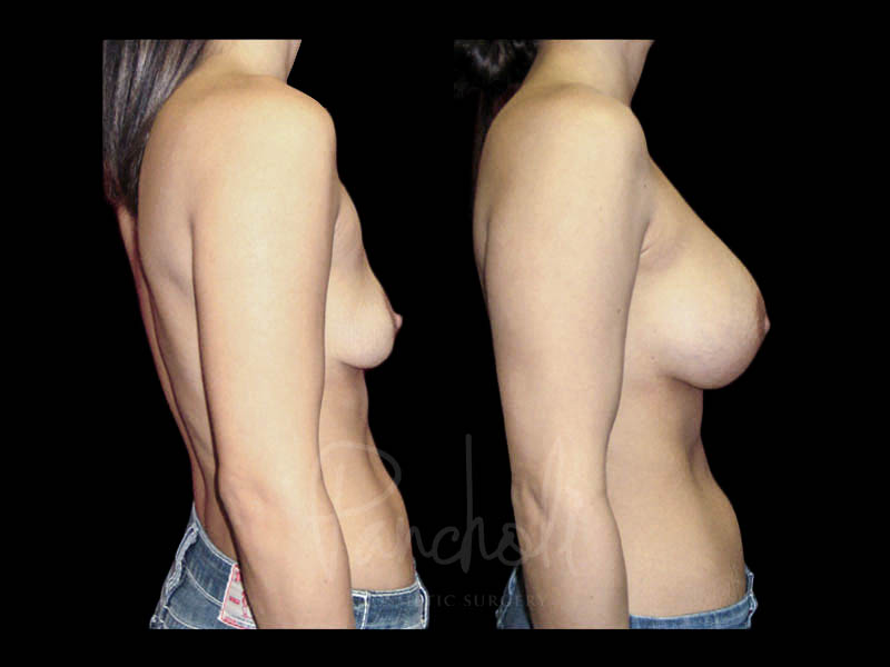 Breast Before After Photos Breast Implant Replacement Before After Photos Case #13577 - Pancholi Cosmetic Surgery
