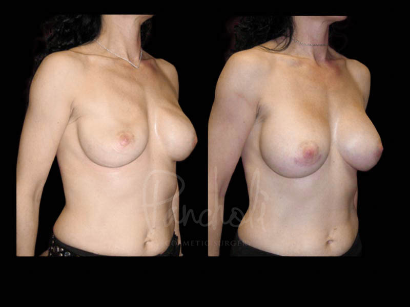 Breast Before After Photos Breast Implant Replacement Before After Photos Case #13579 - Pancholi Cosmetic Surgery