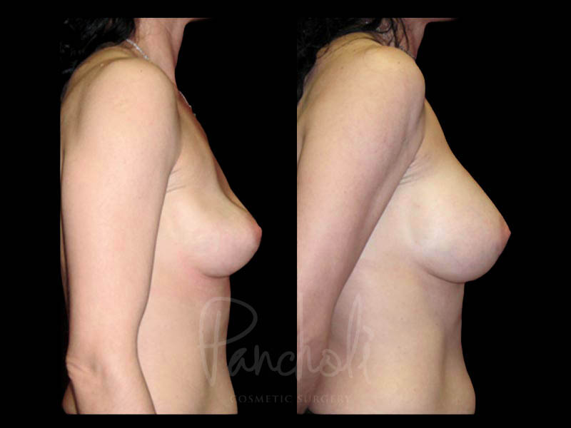 Breast Before After Photos Breast Implant Replacement Before After Photos Case #13580 - Pancholi Cosmetic Surgery