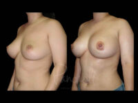 Breast Before After Photos Breast Implant Replacement Before After Photos Case #13582 - Pancholi Cosmetic Surgery
