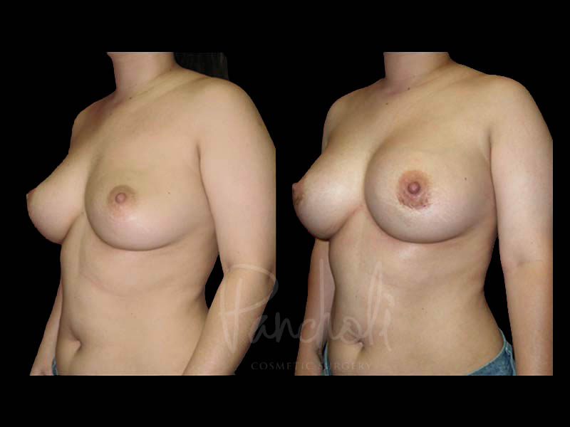 Breast Before After Photos Breast Implant Replacement Before After Photos Case #13582 - Pancholi Cosmetic Surgery