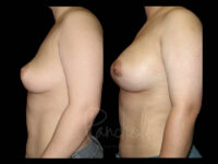 Breast Before After Photos Breast Implant Replacement Before After Photos Case #13583 - Pancholi Cosmetic Surgery