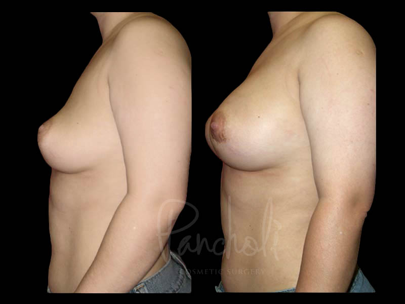 Breast Before After Photos Breast Implant Replacement Before After Photos Case #13583 - Pancholi Cosmetic Surgery
