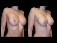 Breast Before After Photos Breast Implant Replacement Before After Photos Case #13585 - Pancholi Cosmetic Surgery