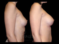 Breast Before After Photos Breast Implant Replacement Before After Photos Case #13586 - Pancholi Cosmetic Surgery
