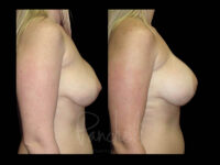Breast Before After Photos Breast Implant Replacement Before After Photos Case #13589 - Pancholi Cosmetic Surgery