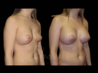 Breast Before After Photos Breast Implant Replacement Before After Photos Case #13591 - Pancholi Cosmetic Surgery