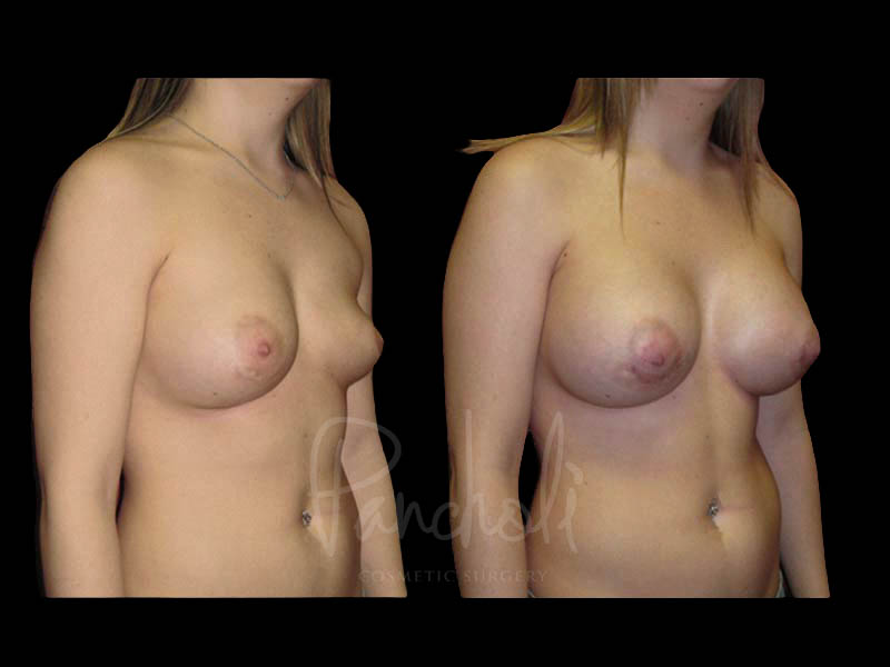 Breast Before After Photos Breast Implant Replacement Before After Photos Case #13591 - Pancholi Cosmetic Surgery