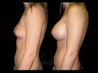 Breast Before After Photos Breast Implant Replacement Before After Photos Case #13592 - Pancholi Cosmetic Surgery